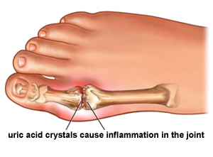gout