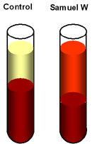 haemolysed