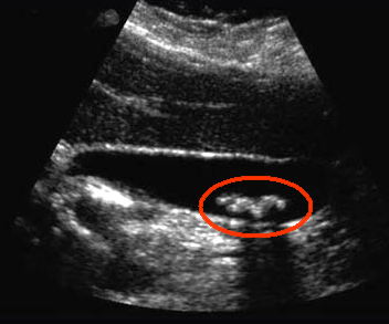 gallstones ultrasound